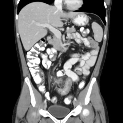 CT abdomen