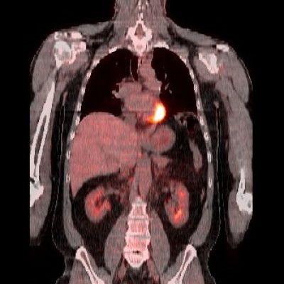 PETCT_cor2